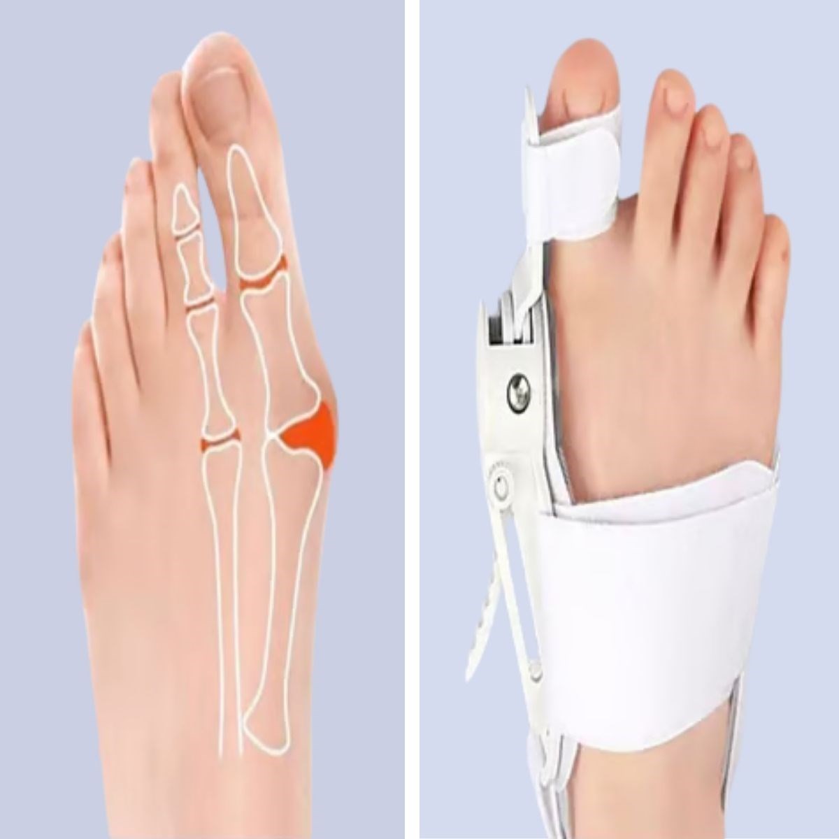 ANKAVERSE® Ayarlanabilir Ayak Baş Parmak Kemik Düzeltici – Halluks Valgus (Bunyon) Aparatı, Gece Gündüz Kullanıma Uygun Ayak Düzeltme Ateli